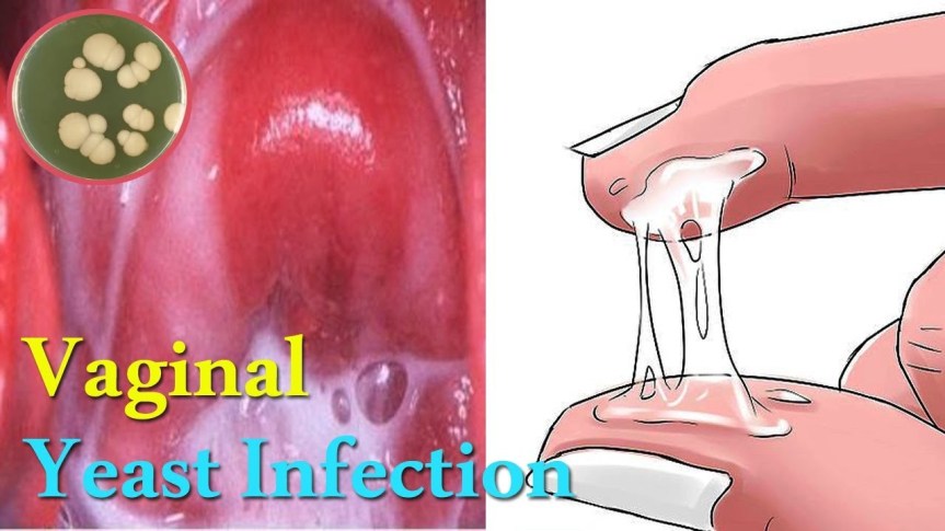 Cottage cheese discharge